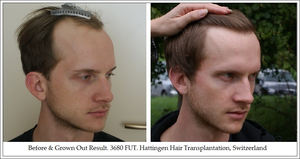 Волосы форум мужчины. Джуд Лоу пересадка волос. Джуд Лоу до и после пересадки волос. Прическа пересадка волос.