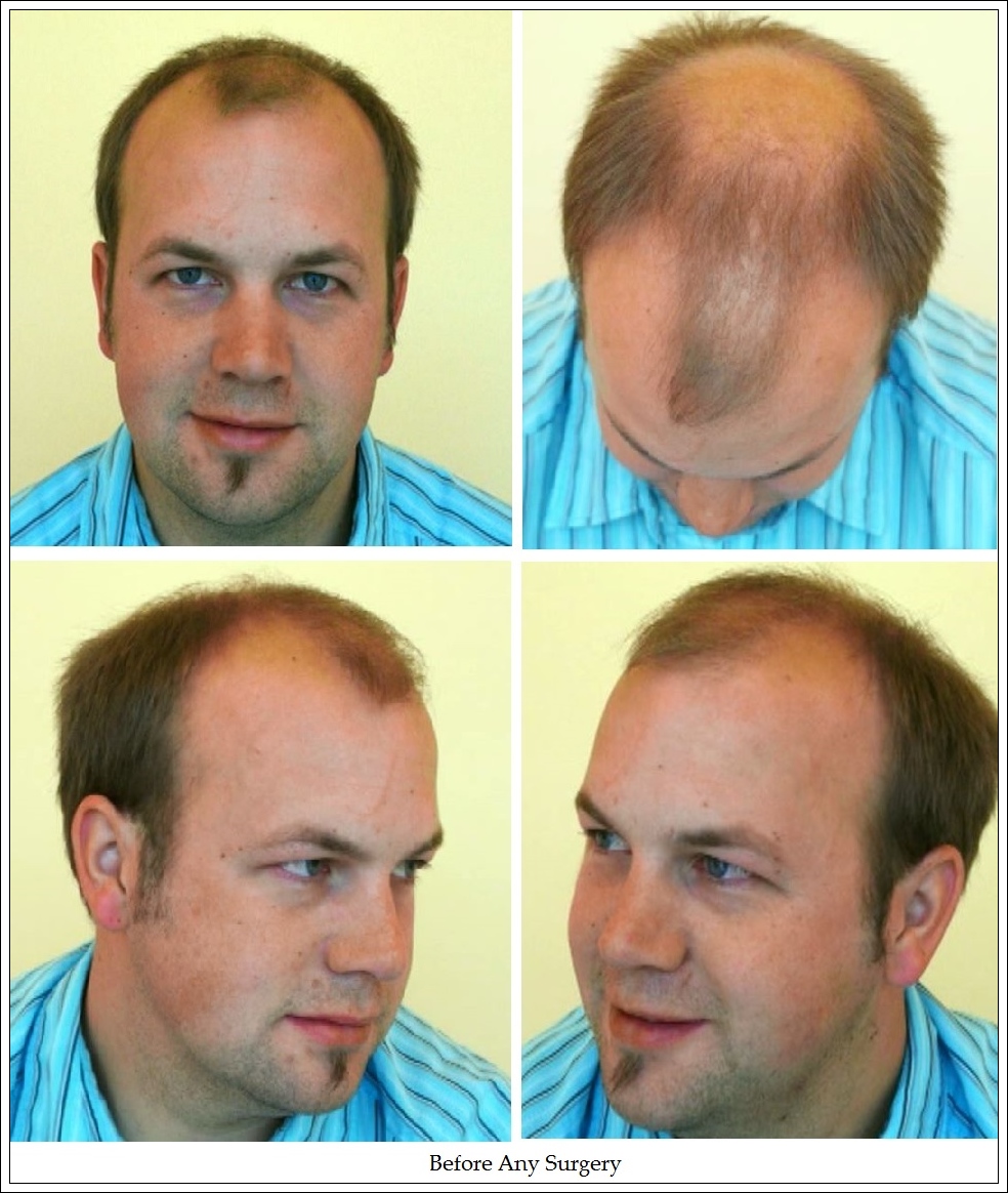 Temporal Recession Page 3 Hattingen Hair Transplantation