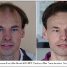 Hair Transplant Results. Hattingen Hair Transplantation (1)
