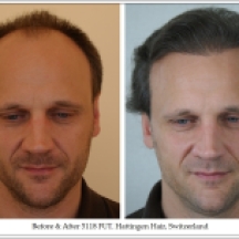 Hair Transplant Results. Hattingen Hair Transplantation (6)