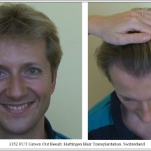 Hair Transplant Results. Hattingen Hair Transplantation (8)