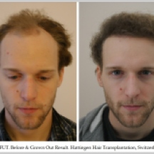 Hair Transplant Results. Hattingen Hair Transplantation (9)